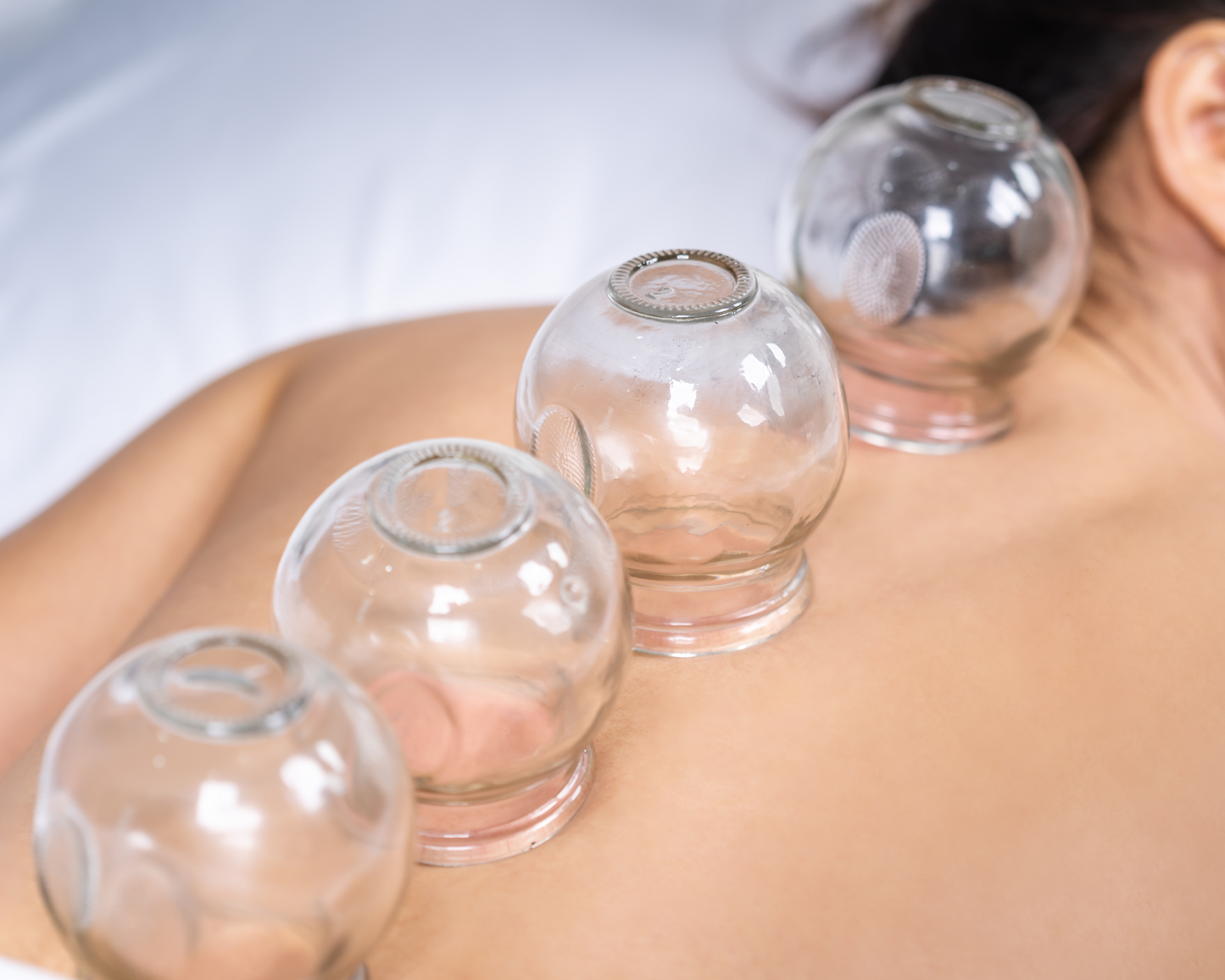 Cupping